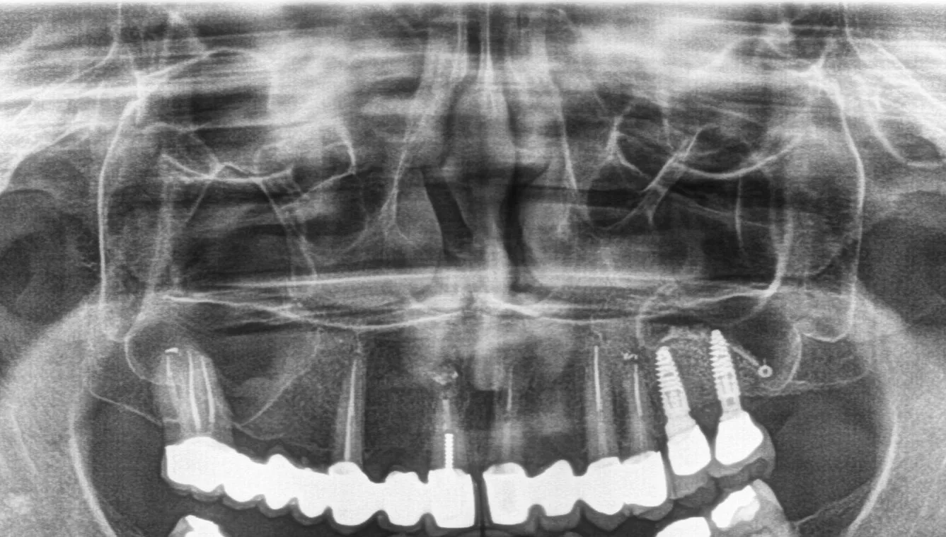 After implant treatment X-ray