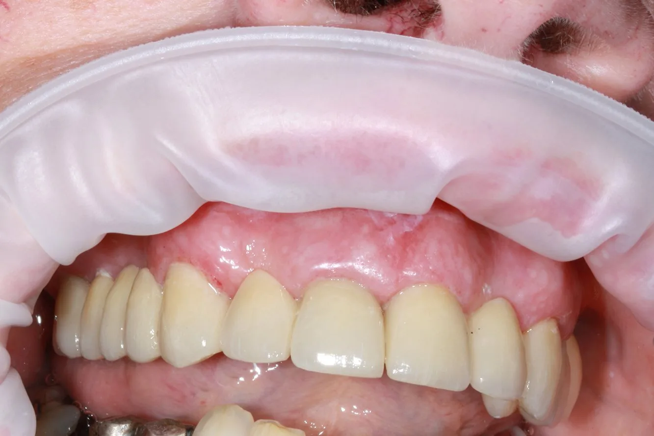 After dental implant reconstruction at Index Medica