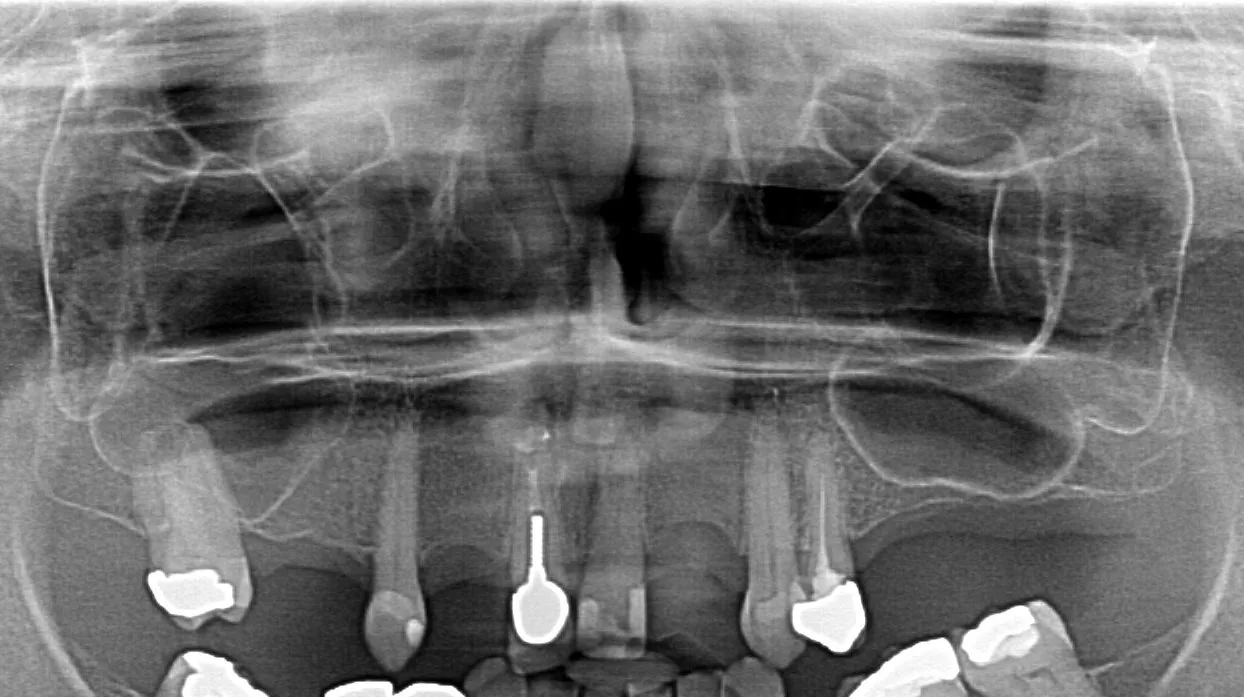 Before implant treatment X-ray