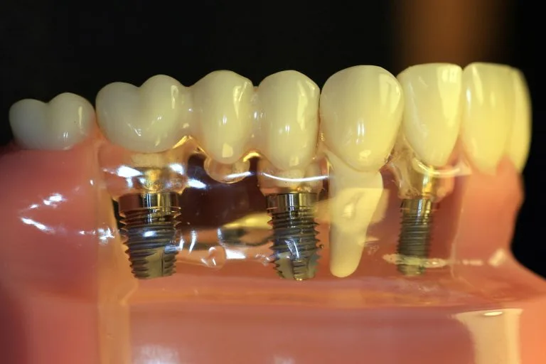 Dental implants supporting prosthetic bridge restoration for missing teeth